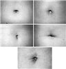 Basic shapes of the umbilicus (belly button) in women.