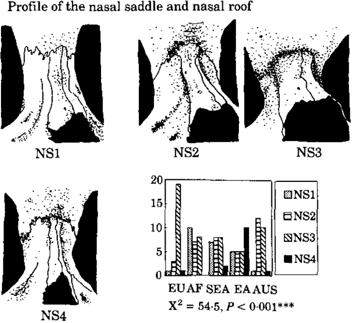Regional distribution of nasal saddle and nasal roof shape.